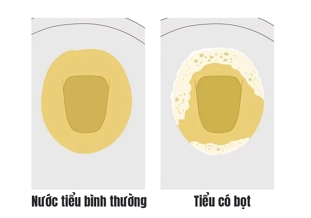 Nước tiểu có bọt: Khi nào là bình thường, khi nào cần lo lắng? Phụ nữ mang thai có thể gặp nước tiểu có bọt, cần theo dõi sức khỏe