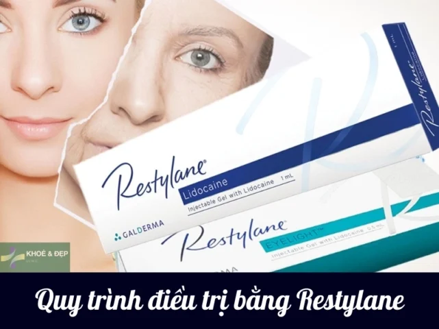 Filler Restylane của nước nào? Giải đáp chi tiết 2026 Quy trình tiêm filler Restylane