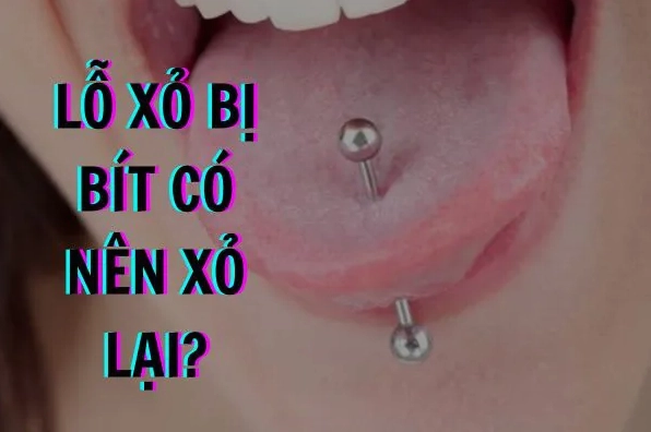 Lỗ Khuyên Tai Bị Bít: Nguyên Nhân, Cách Xử Lý Và Phòng Ngừa Hiệu Quả Điều trị lỗ khuyên tai bị bít do viêm nhiễm