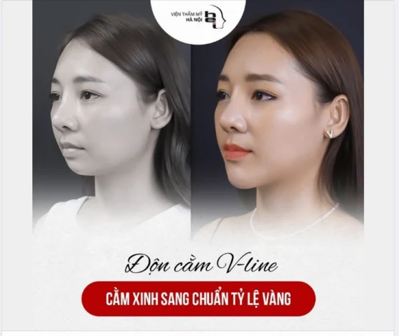 Khắc phục cằm ngắn: Giải pháp toàn diện cho khuôn mặt cân đối 2026 Minh họa ảnh hưởng của cằm ngắn đến khuôn mặt