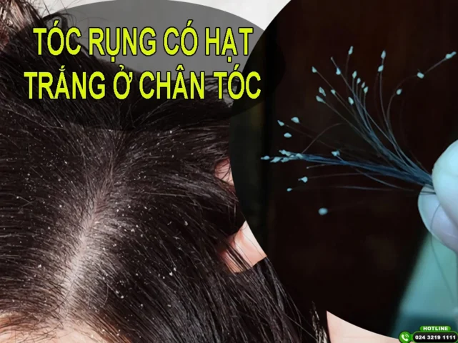 Chân Tóc Có Hạt Trắng: Nguyên Nhân, Cách Điều Trị & Phòng Ngừa Hiệu Quả 2026 Tóc rụng có hạt trắng ở chân tóc